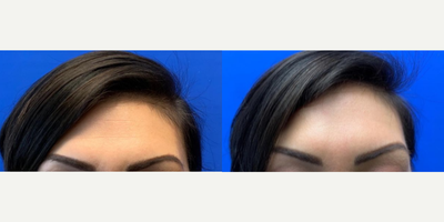 Case: 4458 - before and after photo of Woman treated with Botox by Shahram Salemy, MD, FACS