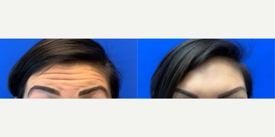 Case: 4459 - before and after photo of Woman treated with Botox by Shahram Salemy, MD, FACS