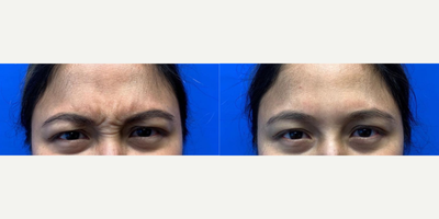 Case: 4460 - before and after photo of Woman treated with Botox by Shahram Salemy, MD, FACS