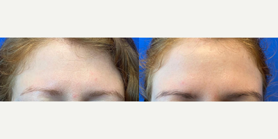 Case: 4461 - before and after photo of Woman in her 20s treated with Botox by Shahram Salemy, MD, FACS
