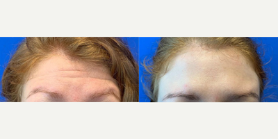 Case: 4462 - before and after photo of Woman in her 20s treated with Botox by Shahram Salemy, MD, FACS