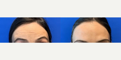 Case: 4463 - before and after photo of Woman treated with Botox by Shahram Salemy, MD, FACS