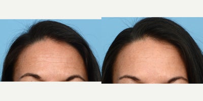 Case: 4464 - before and after photo of 45-54 year old woman treated with Botox by Jeffrey B. Wise, MD, FACS