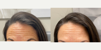 Case: 4465 - before and after photo of 45-54 year old woman treated with Botox by Jeffrey B. Wise, MD, FACS
