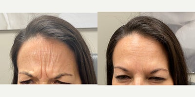 Case 4466 - 45-54 year old woman treated with Botox