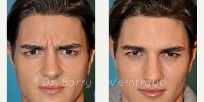 Case 4467 - Man treated with Botox