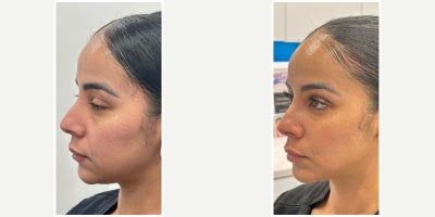 Case 4468 - 35-44 year old woman treated with Dermal Fillers, Botox, Nonsurgical Neck Lift