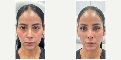 Case 4469 - 35-44 year old woman treated with Dermal Fillers, Botox, Nonsurgical Neck Lift