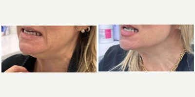 Case 4470 - 45-54 year old woman treated with Nonsurgical Neck Lift, Botox