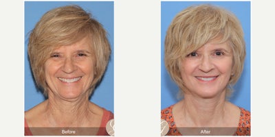 Case 4471 - 67 year old woman treated with Lower Facelift, Facelift, Neck Lift, Botox