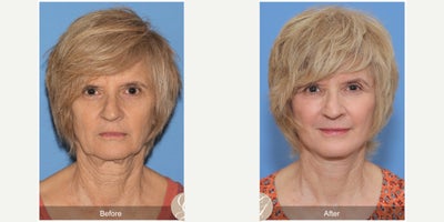 Case 4472 - 67 year old woman treated with Lower Facelift, Facelift, Neck Lift, Botox