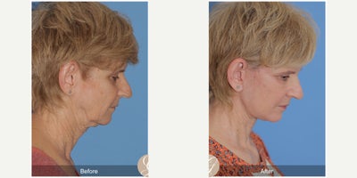 Case 4473 - 67 year old woman treated with Lower Facelift, Facelift, Neck Lift, Botox