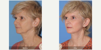 Case 4474 - 67 year old woman treated with Lower Facelift, Facelift, Neck Lift, Botox