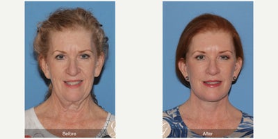 Case 4475 - 62 year old woman treated with Deep Plane Facelift, Neck Lift, Botox, MACS Facelift