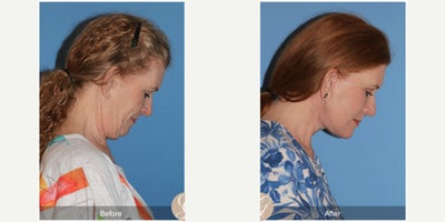 Case 4476 - 62 year old woman treated with Deep Plane Facelift, Neck Lift, Botox, MACS Facelift
