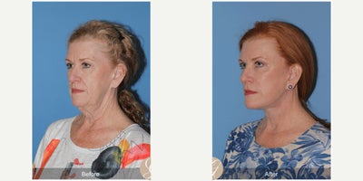 Case 4477 - 62 year old woman treated with Deep Plane Facelift, Neck Lift, Botox, MACS Facelift