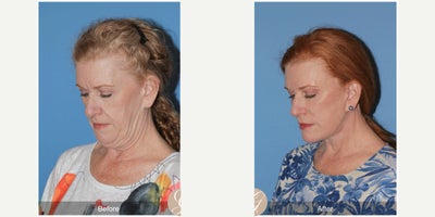 Case 4478 - 62 year old woman treated with Deep Plane Facelift, Neck Lift, Botox, MACS Facelift