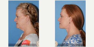 Case 4479 - 62 year old woman treated with Deep Plane Facelift, Neck Lift, Botox, MACS Facelift