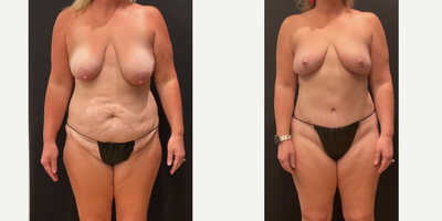 Case 448 - 35-44 year old woman treated with Mommy Makeover, Breast Lift, Tummy Tuck