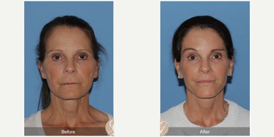 Case 4480 - 57 year old woman treated with Deep Plane Facelift, Facelift, Neck Lift, Brow Lift, Facial Fat Transfer, Lip Lift, CO2 Laser, Bo