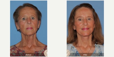 Case 4481 - 69 year old woman treated with Deep Plane Facelift, Facelift, Neck Lift, Brow Lift, CO2 Laser, Eyelid Surgery, Botox
