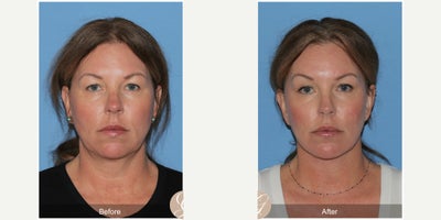 Case 4485 - 51 year old woman treated with Deep Plane Facelift, Facelift, Neck Lift, Brow Lift, Botox, MACS Facelift
