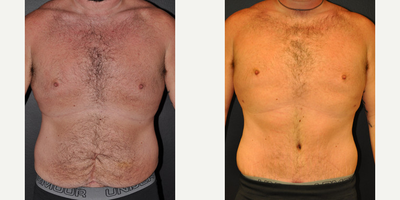 Case 449 - 36 year old woman treated with Liposuction, Tummy Tuck