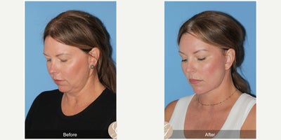 Case 4490 - 51 year old woman treated with Deep Plane Facelift, Facelift, Neck Lift, Brow Lift, Botox, MACS Facelift