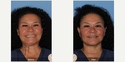 Case 4492 - 49 year old woman treated with Deep Plane Facelift, Facelift, Neck Lift, Botox