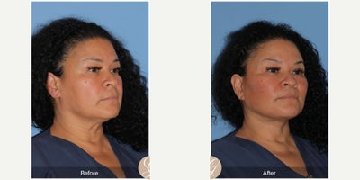 Case 4493 - 49 year old woman treated with Deep Plane Facelift, Facelift, Neck Lift, Botox