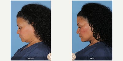 Case 4494 - 49 year old woman treated with Deep Plane Facelift, Facelift, Neck Lift, Botox