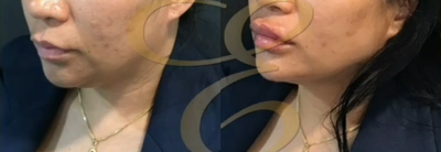 Case 4495 - Woman treated with Botox, Lip Fillers
