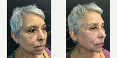 Case 4497 - Woman treated with Restylane Lyft, Botox