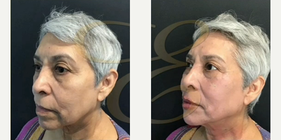 Case 4498 - Woman treated with Restylane Lyft, Botox