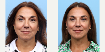 Case 4499 - 55-64 year old woman treated with Nonsurgical Facelift, Botox