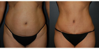 Case 450 - Woman treated with Tummy Tuck