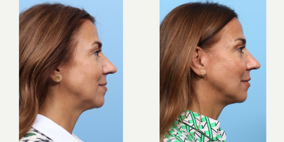 Case 4500 - 55-64 year old woman treated with Nonsurgical Facelift, Botox