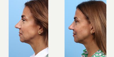 Case 4501 - 55-64 year old woman treated with Nonsurgical Facelift, Botox