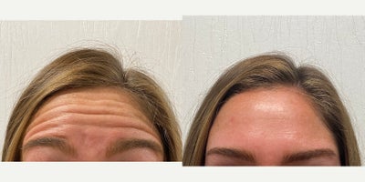 Case 4502 - 18-24 year old woman treated with Botox