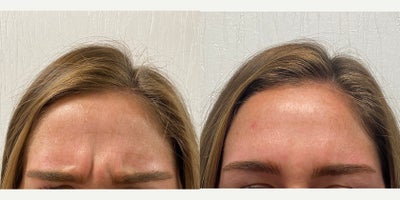 Case 4503 - 18-24 year old woman treated with Botox