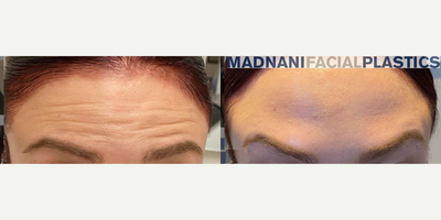 Case 4504 - Woman treated with Botox