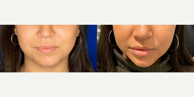 Case 4505 - Woman treated with Botox