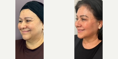 Case 4506 - Woman treated with Botox