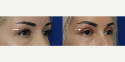 Case 4507 - Woman treated with Botox