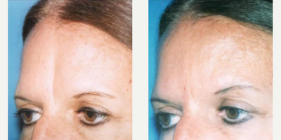 Case 4508 - Woman treated with Botox