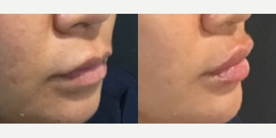 Case 4509 - Woman treated with Botox