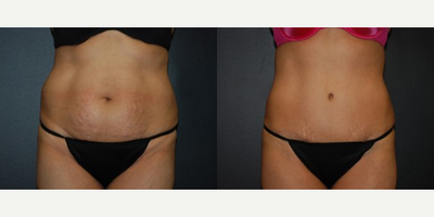 Case 451 - Woman treated with Tummy Tuck