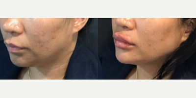 Case 4510 - Woman treated with Botox