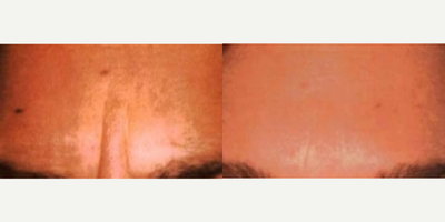 Case 4512 - Patient treated with Botox