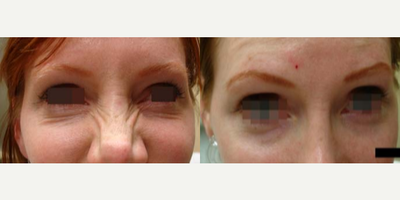 Case 4513 - Woman treated with Botox